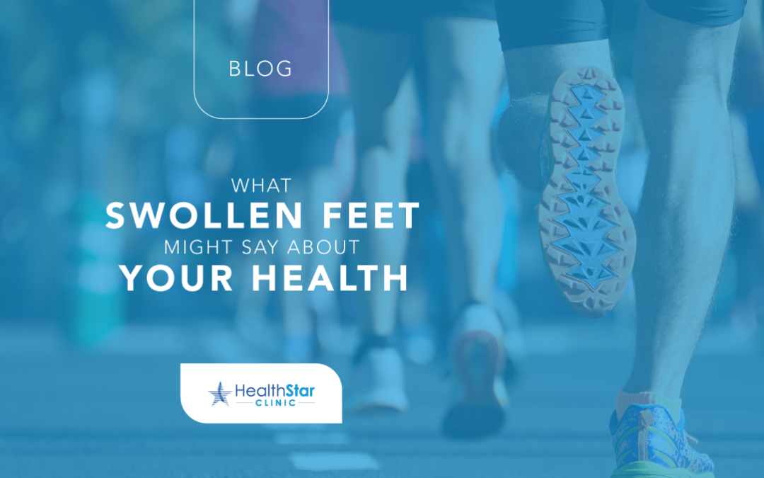 What Swollen Feet Might Say About Your Health