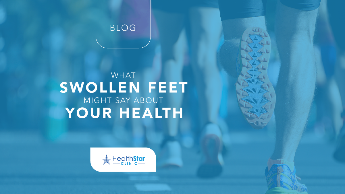 What Swollen Feet Might Say About Your Health